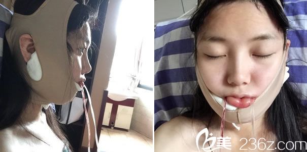 下頜角整形手術(shù)后戴頭套照片