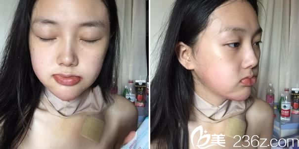 下頜角手術(shù)第3天拔引流管照片