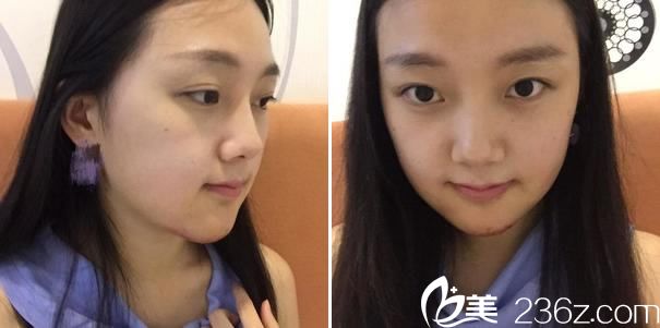 下頜角手術(shù)第4天照片