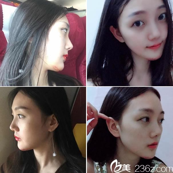 做下頜角手術(shù)第10天的效果