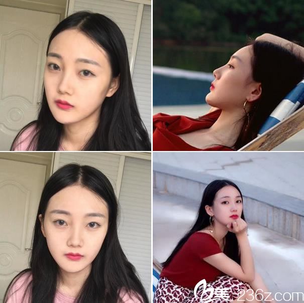 下頜角改臉型手術(shù)15天恢復(fù)圖