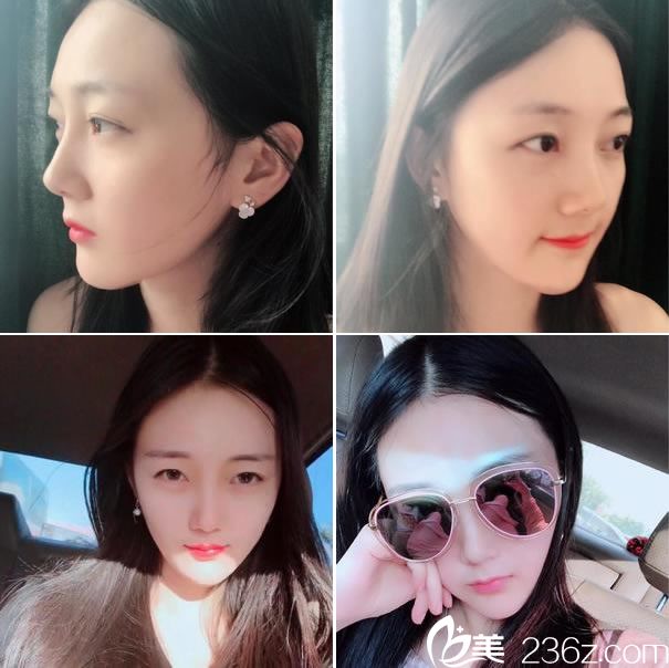 <!--<i data=20240703-sp></i>-->做下頜角22天效果