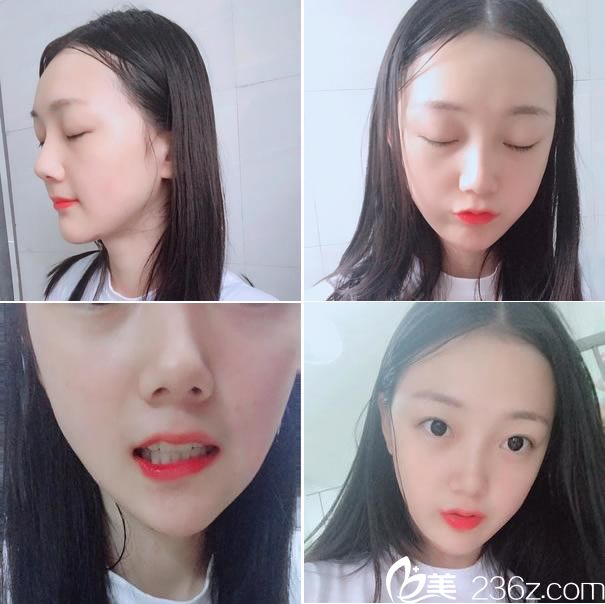 下頜角手術(shù)第35天恢復(fù)效果