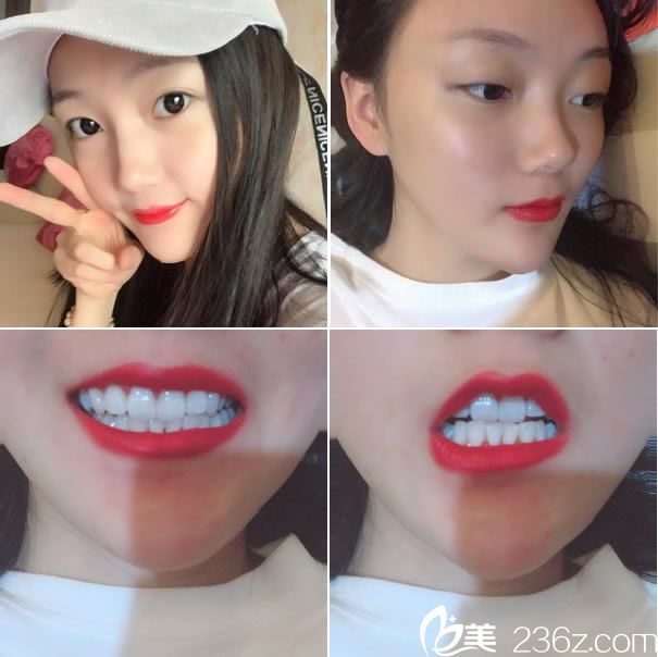 小V臉手術(shù)第55天恢復(fù)圖片