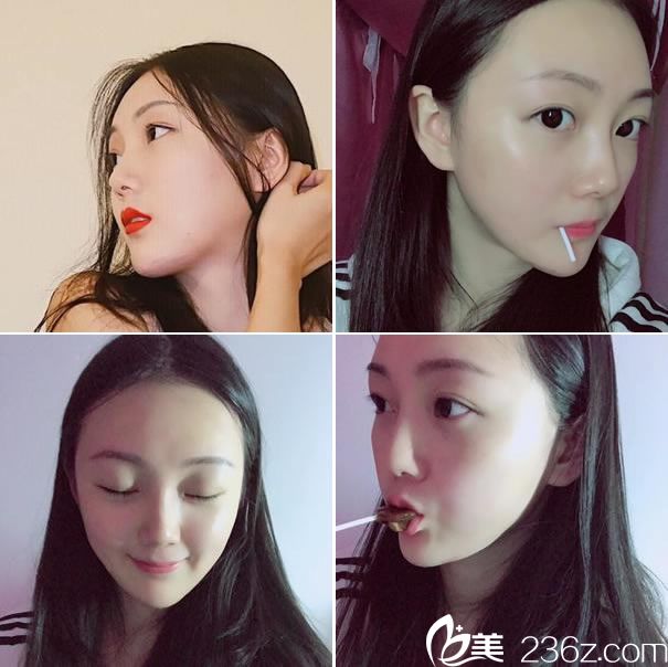 杭州整形唐冬生做下頜角效果