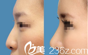 韓國(guó)藝德雅整形外科案例 韓國(guó)藝德雅整形外科案例