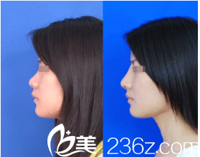 韓國(guó)藝德雅整形外科案例 韓國(guó)藝德雅整形外科案例