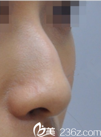 韓國(guó)藝德雅整形外科案例 韓國(guó)藝德雅整形外科案例