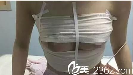 術后第四天隆胸恢復