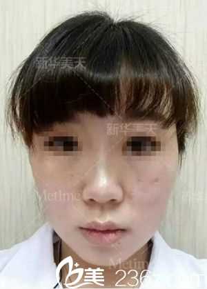 在大連新華美天做隆鼻手術(shù)前 在大連新華美天做隆鼻手術(shù)前
