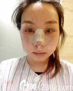 在大連新華美天做隆鼻手術(shù)當(dāng)天.jpg 在大連新華美天做隆鼻手術(shù)當(dāng)天.jpg