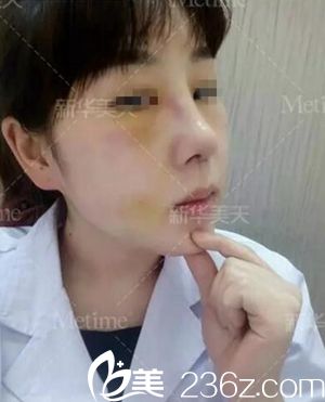 在大連新華美天做隆鼻手術(shù)后4天.jpg 在大連新華美天做隆鼻手術(shù)后4天.jpg