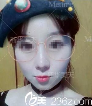 在大連新華美天做隆鼻手術(shù)后2周.jpg 在大連新華美天做隆鼻手術(shù)后2周.jpg