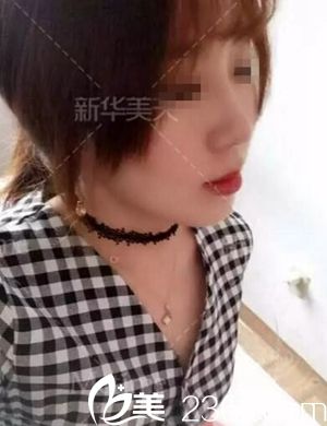 在大連新華美天做隆鼻手術(shù)后1個月.jpg 在大連新華美天做隆鼻手術(shù)后1個月.jpg