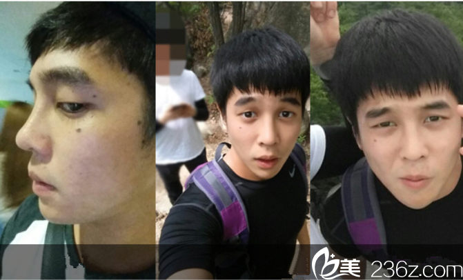 手術前后對比圖