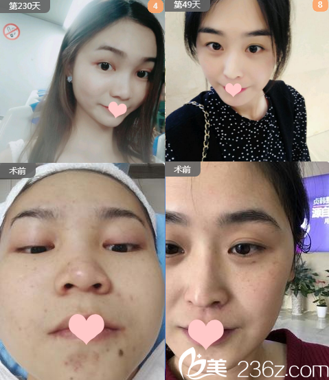 南寧貞韓醫(yī)療美容門診部郝帥美膚案例