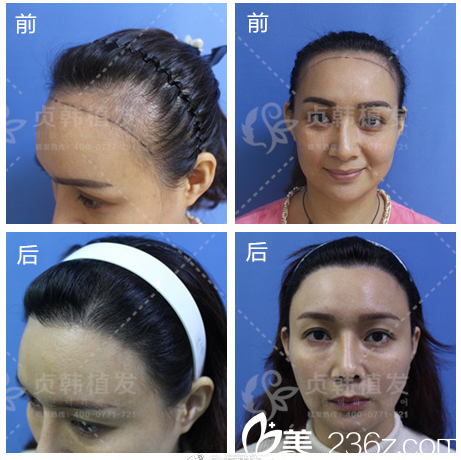 南寧貞韓整形醫(yī)院郝帥植發(fā)案例