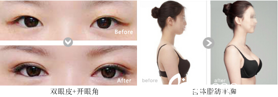 郭芮君雙眼皮+自體脂肪豐胸案例對(duì)比圖 郭芮君雙眼皮+自體脂肪豐胸案例對(duì)比圖