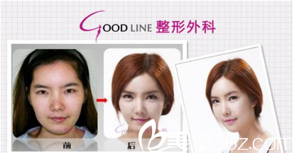 韓國(guó)GOOD-LINE崔德浩整形外科案例 韓國(guó)GOOD-LINE崔德浩整形外科案例