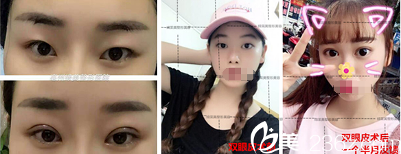 亳州締美李士成雙眼皮整形案例 亳州締美李士成雙眼皮整形案例