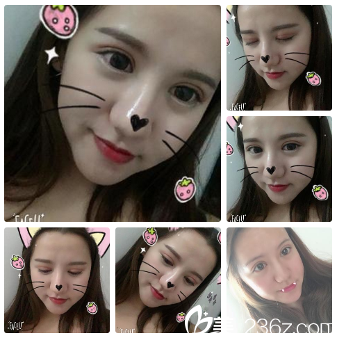 看南寧貞韓美容醫(yī)院內(nèi)部員工找邵菊麗醫(yī)生做的雙眼皮好不好