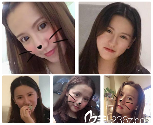 找南寧貞韓邵菊麗主任做雙眼皮1個月了 找南寧貞韓邵菊麗主任做雙眼皮1個月了