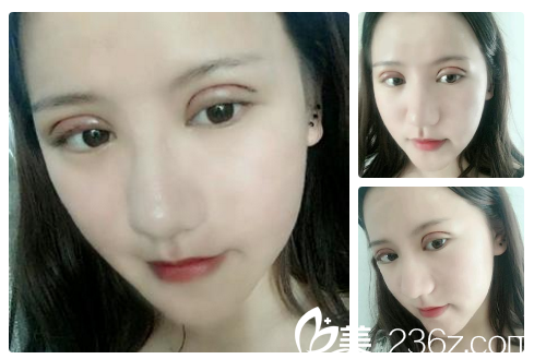 在南寧貞韓做完雙眼皮5天自拍 在南寧貞韓做完雙眼皮5天自拍