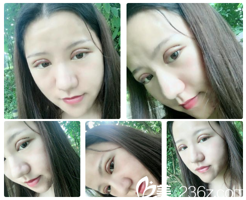 南寧貞韓美容醫(yī)院雙眼皮2天效果 南寧貞韓美容醫(yī)院雙眼皮2天效果