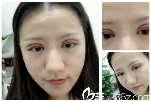 雙眼皮做完天的樣子 雙眼皮做完天的樣子