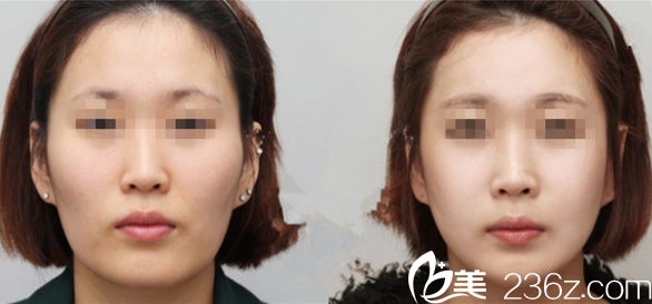 韓國GOOD LINE崔德浩整形外科案例 韓國GOOD LINE崔德浩整形外科案例