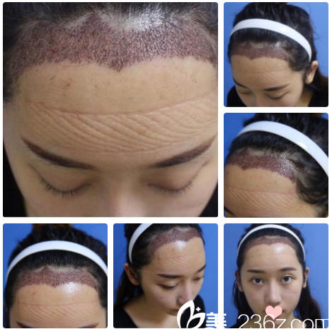 南寧貞韓發(fā)際線種植第二天自拍 南寧貞韓發(fā)際線種植第二天自拍