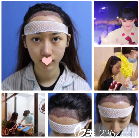 南寧貞韓植發(fā)醫(yī)院發(fā)際線種植天效果 南寧貞韓植發(fā)醫(yī)院發(fā)際線種植天效果