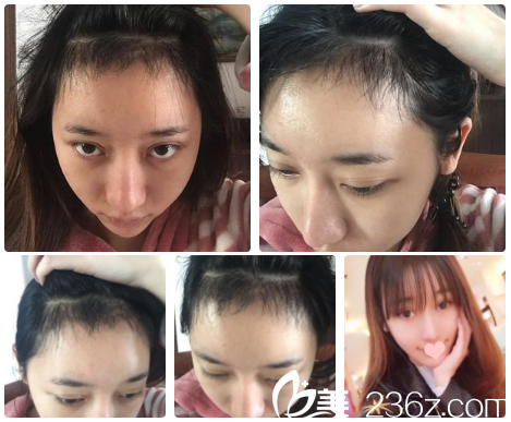 南寧貞韓發(fā)際線種植2個月效果 南寧貞韓發(fā)際線種植2個月效果