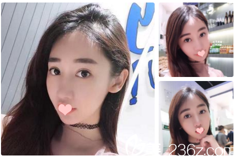 看我花2萬多元在南寧貞韓植發(fā)醫(yī)院做的發(fā)際線種植效果怎么樣