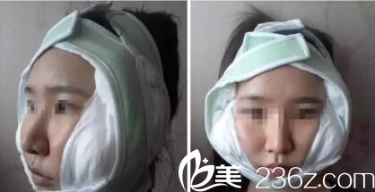 韓國iWell愛我整形外科真人案例術(shù)后天 韓國iWell愛我整形外科真人案例術(shù)后天