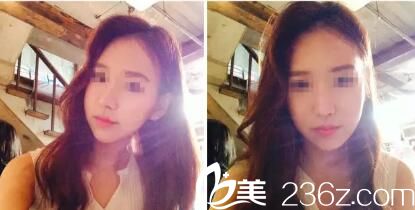   韓國(guó)iWell愛我整形外科醫(yī)院樸范鎮(zhèn)院長(zhǎng)做顴骨效果怎么樣？顴骨縮小真人案例