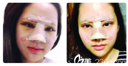 深圳美萊梁志為雙眼皮+隆鼻第4天效果 深圳美萊梁志為雙眼皮+隆鼻第4天效果