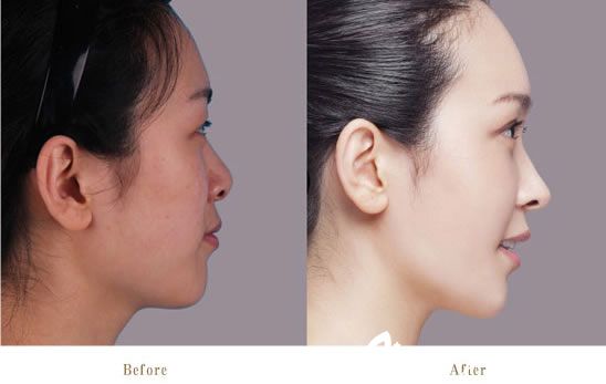 溫州藝星譚立文鼻綜合真人效果 溫州藝星譚立文鼻綜合真人效果