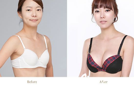 溫州藝星譚立文隆胸真人效果 溫州藝星譚立文隆胸真人效果