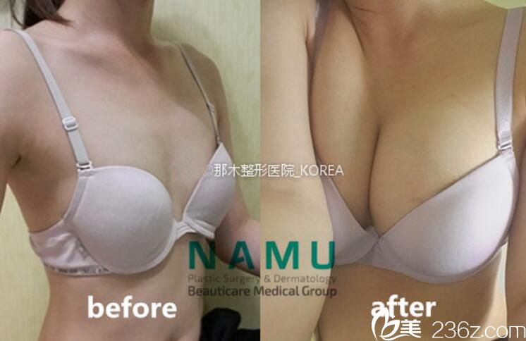 崔碩珉隆胸 崔碩珉隆胸
