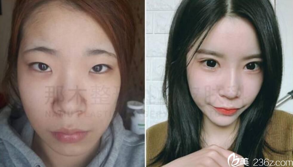 隆鼻案例 吳光振