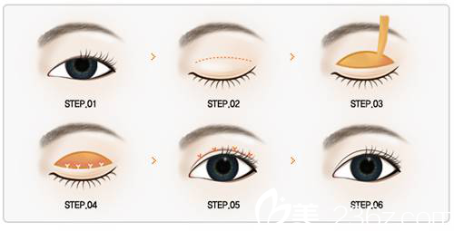 韓國(guó)JK整形外科醫(yī)院張佑碩醫(yī)生介紹雙眼皮