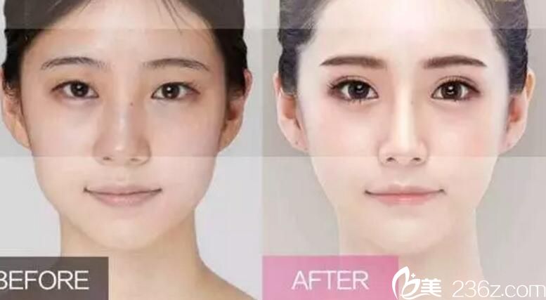 金洞河雙眼皮案例 金洞河雙眼皮案例