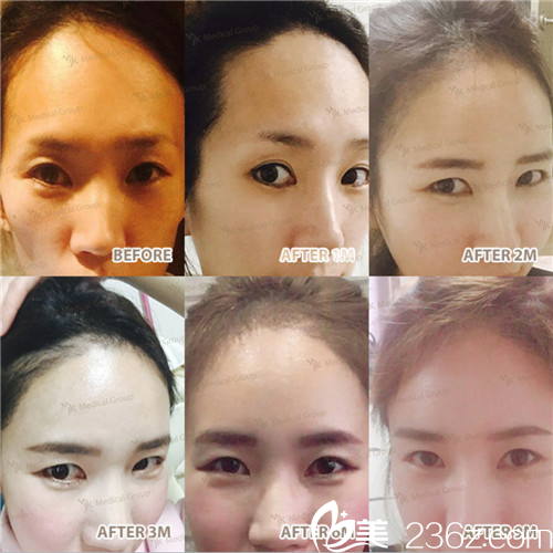 韓國JK整形外科醫(yī)院崔允碩醫(yī)生植發(fā)手術(shù)案例 韓國JK整形外科醫(yī)院崔允碩醫(yī)生植發(fā)手術(shù)案例