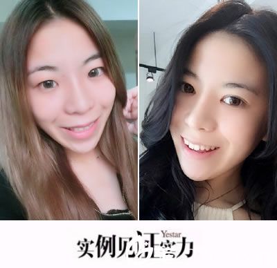 溫州藝星黃樂(lè)切開(kāi)雙眼皮真人效果 溫州藝星黃樂(lè)切開(kāi)雙眼皮真人效果