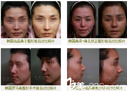 韓國O&YOUNG整形外科案例