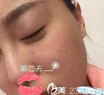 南陽艾美水光注射第二天