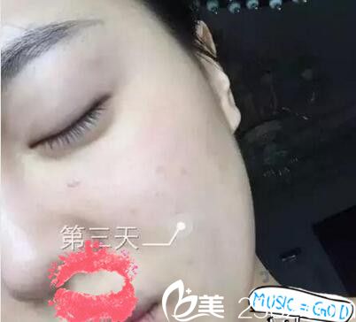 南陽艾美水光注射第三天