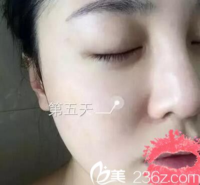 南陽艾美水光注射第五天