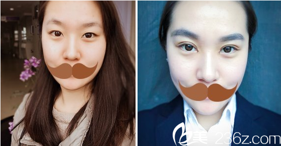 閆品行切開(kāi)雙眼皮術(shù)前術(shù)后對(duì)比 閆品行切開(kāi)雙眼皮術(shù)前術(shù)后對(duì)比